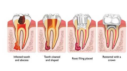 Edgecliff Root Canal Therapy