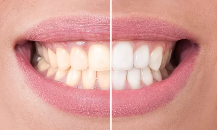 Read more about the article Is Teeth Whitening Harmful To Teeth