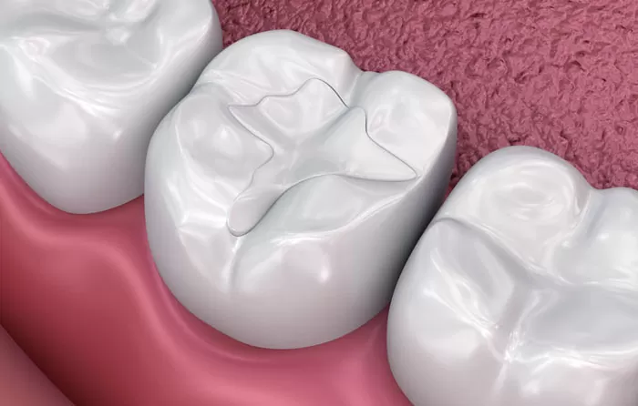 Read more about the article Which dental filling is suited for you?