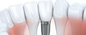 Read more about the article How do dental implants help with bone loss and gum diseases?