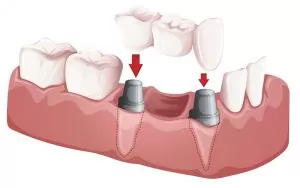 Read more about the article All you need to know about dental implants