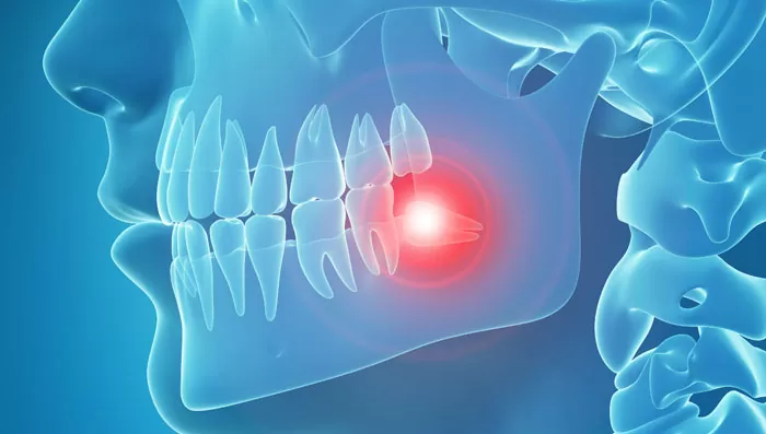 Read more about the article Dental Issues and Wisdom Teeth