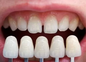 Read more about the article 5 Tips To Determine If Porcelain Veneers Suit You