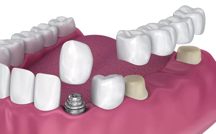 Read more about the article Should you opt for a dental implant or a dental bridge?